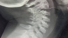 Двухлетняя девочка из Подмосковья неделю провела с проволокой в горле