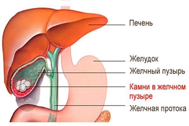 Камни в желчном пузыре – можно ли растворить, варианты лечения без операции