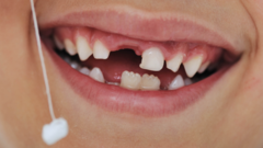 У 34-летней женщины выпали зубы из-за необычной болезни