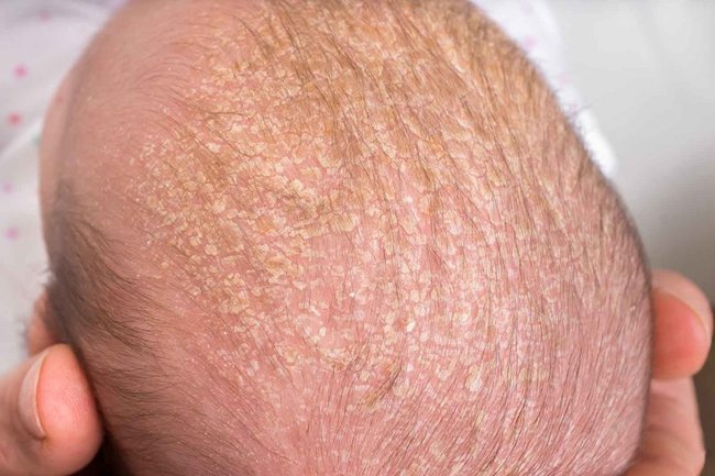 Лечение болячек и ранок на коже головы — Причины появления корок в волосах - Клиника «Доктор Волос»