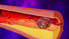 Раскрыты неочевидные признаки оторвавшегося тромба