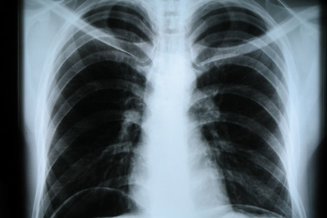 На Ямале снижается число заболевших туберкулезом