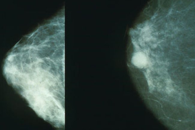 От нашего завода – к вашей груди: особенности кабардинской маммографии
