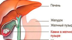 Врач назвал опасным популярный способ похудения